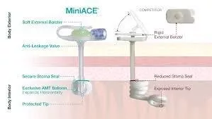Applied Medical Tech ACE-1020 - MiniACE Low Profile Antegrade Continence Enema Button, 10F x 2.0 cm. Boxed Kit